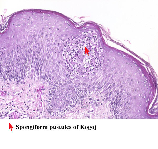 Spongiform pustule.jpg